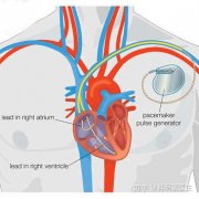 认识心脏起搏器